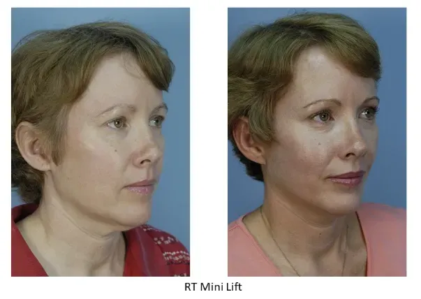 Before and after RT mini lift procedure.