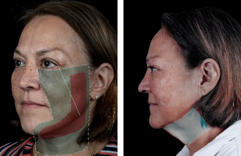 Facial mapping analysis on human model.