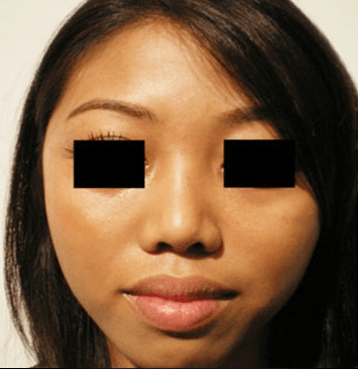 Asian rhinoplasty