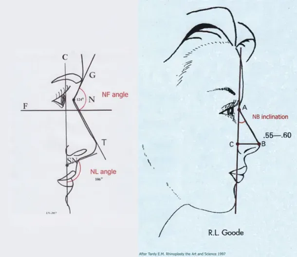 Facial angle measurements in rhinoplasty analysis.