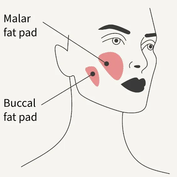 midface lift 2