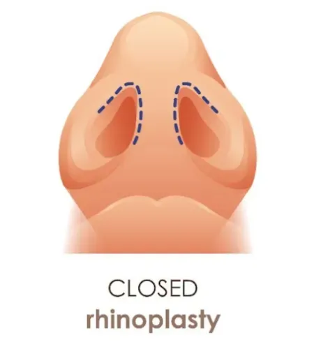 closed-rhinoplasty