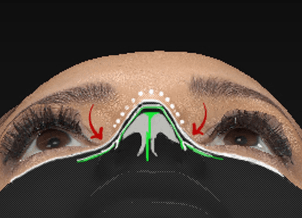 dorsal-preservation-rhinoplasty-1