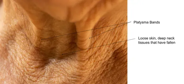 platysma diagram2