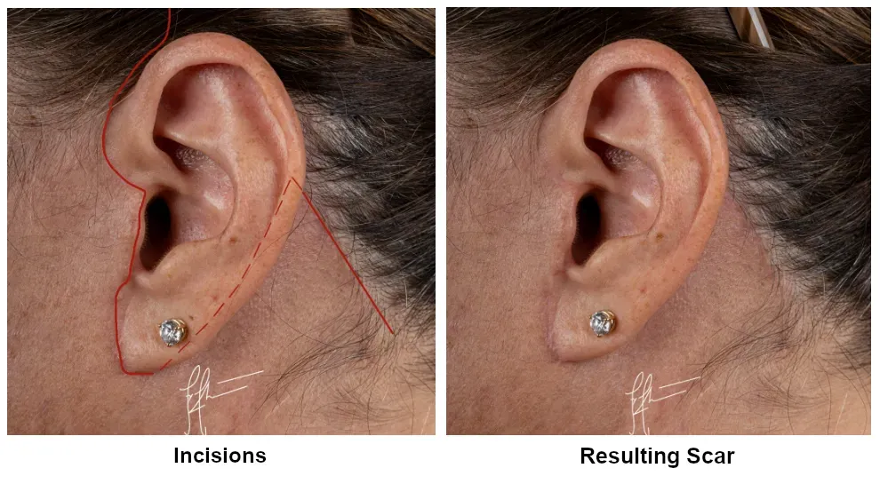 deep plane facelift incision