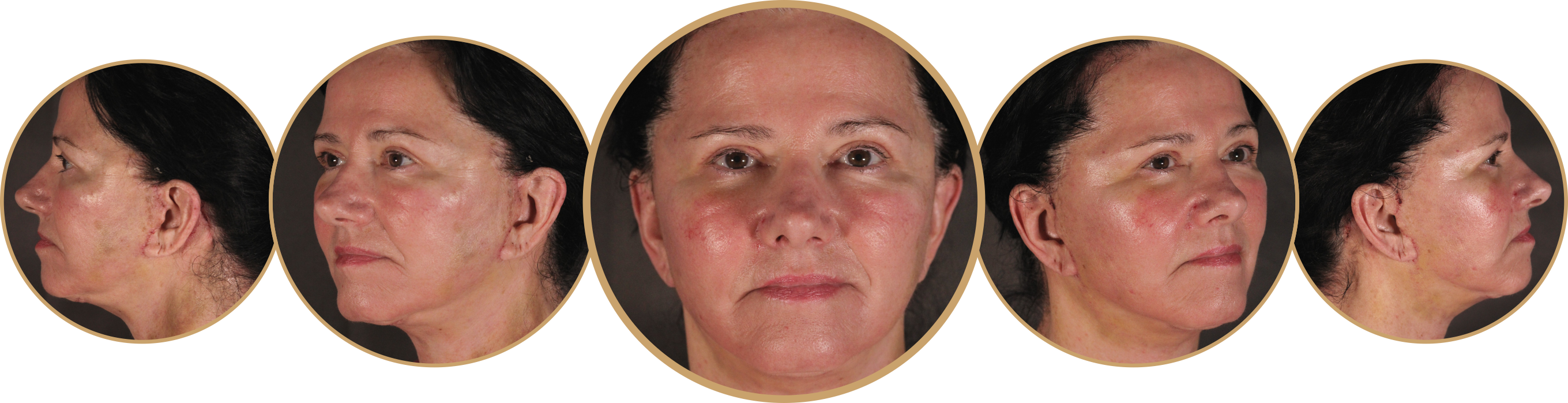 Five perspectives of Patient KVu's face 11 days after surgery.