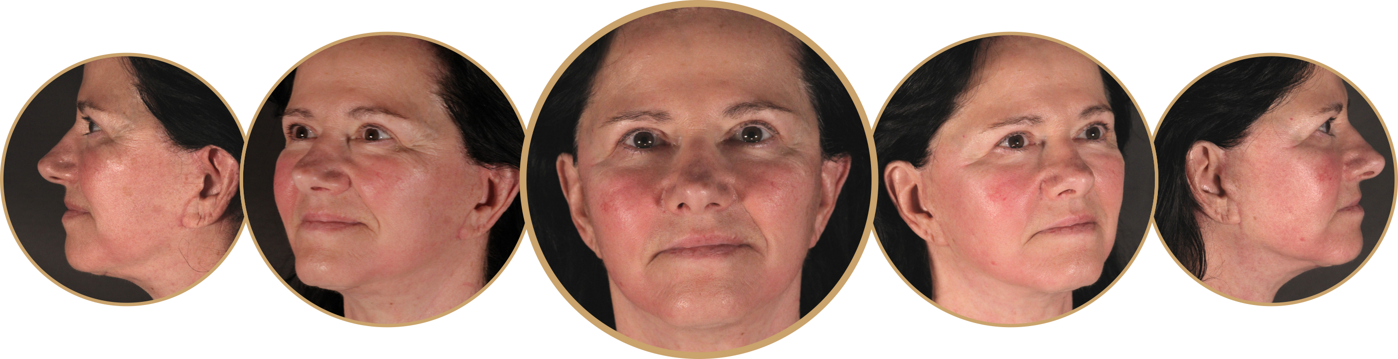 Five perspectives of Patient KVu's face 8 weeks after surgery.
