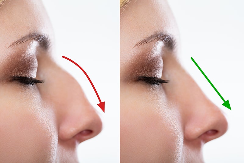 Close up portrait of woman's nose in profile before and after
