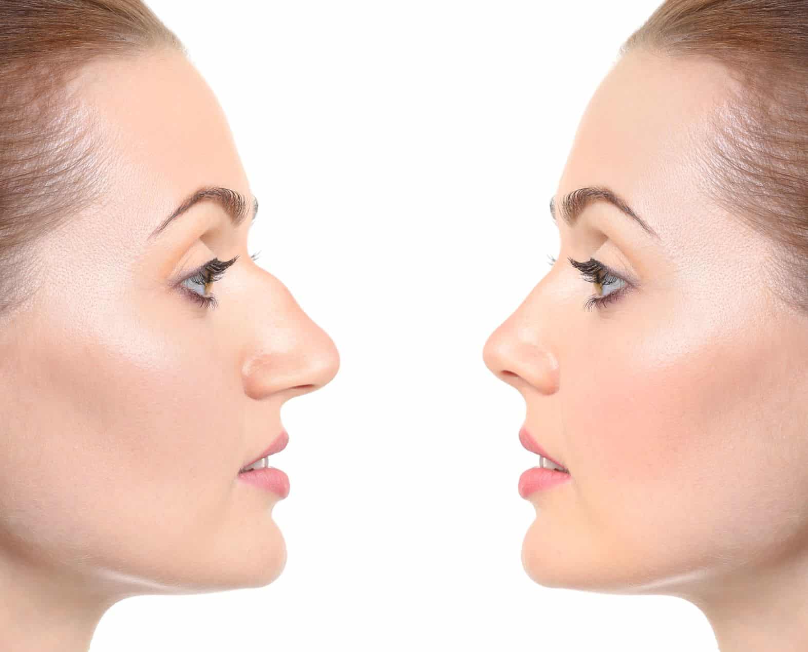 Before and after photos of woman with rhinoplasty