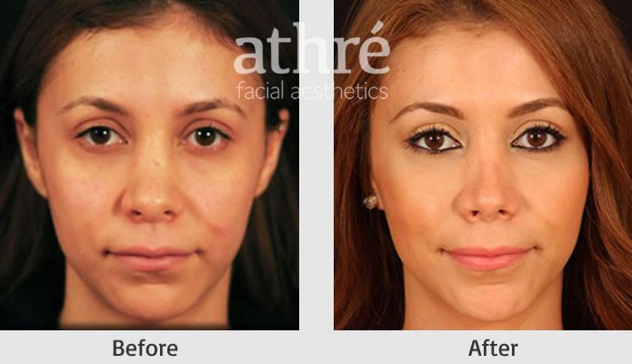Close up of patient's face before and after revision rhinoplasty procedure.