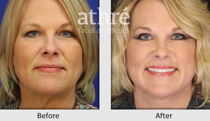 Close up of patient's face before and after facelift procedure.