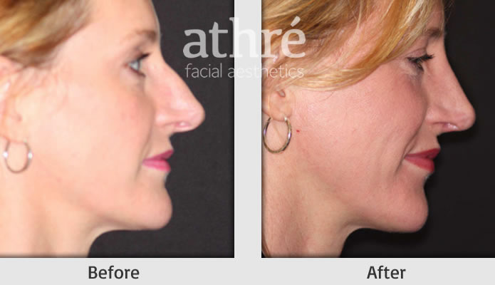 Close up of patient's face before and after rhinoplasty procedure.