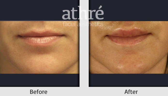 Close up of patient's face before and after lip lift procedure.