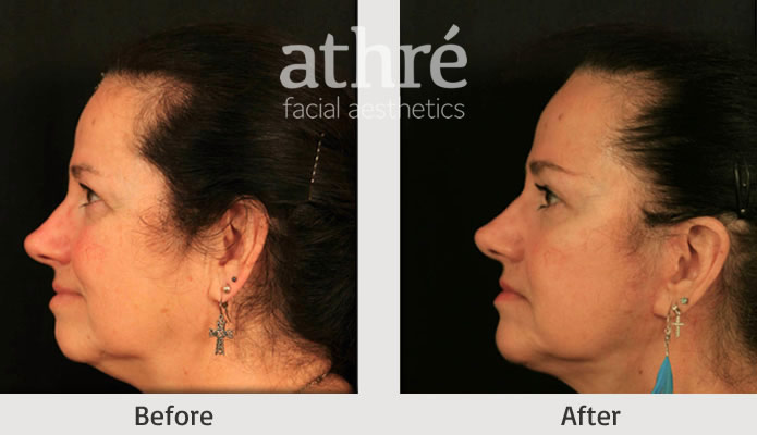 Close up of patient's face before and after chin implant procedure.