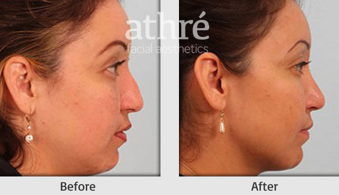 Close up of patient's face before and after revision rhinoplasty procedure.
