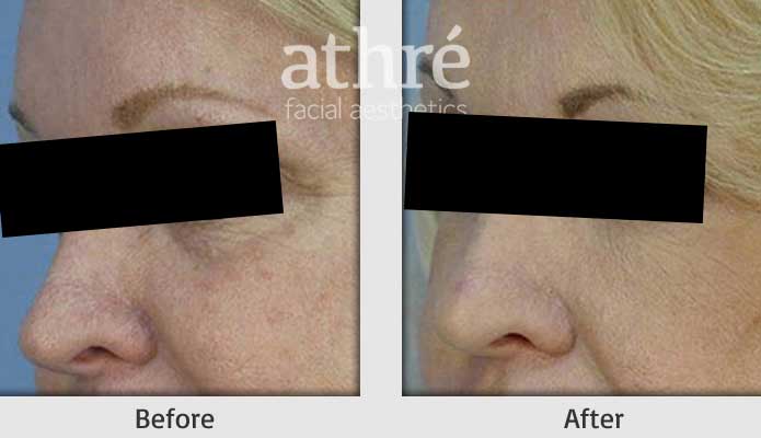 Close up of patient's face before and after facial fillers treatment.