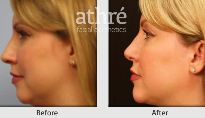 Close up of patient's face before and after chin implant procedure.