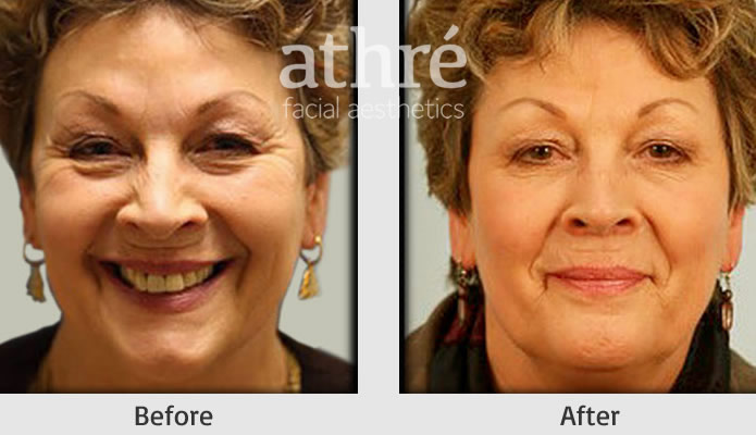 Close up of patient's face before and after Botox treatment.