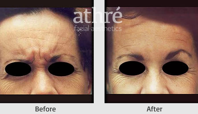 Close up of patient's face before and after Botox treatment.