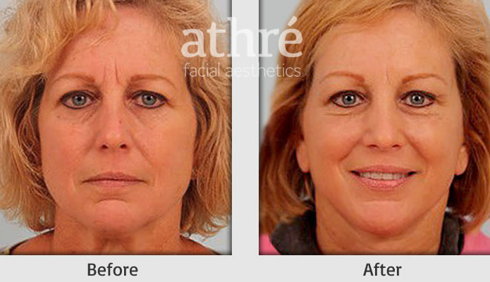 Close up of patient's face before and after brow lift procedure.