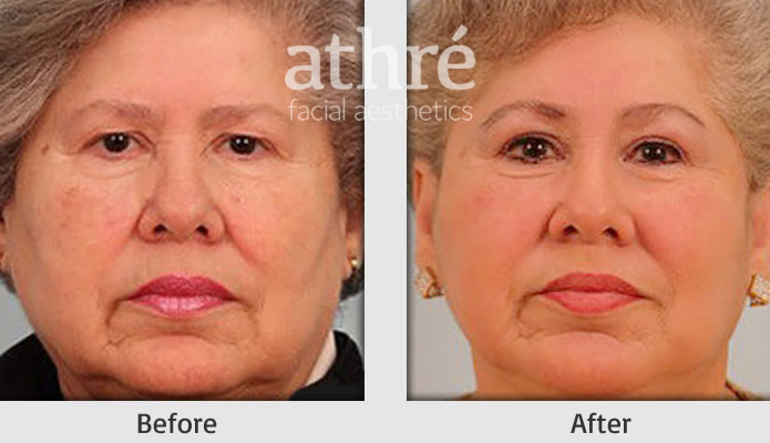 Close up of patient's face before and after brow lift procedure.