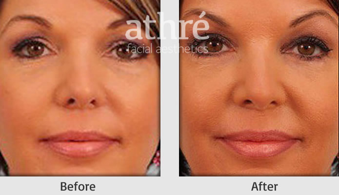 Close up of patient's face before and after eyelid surgery procedure.