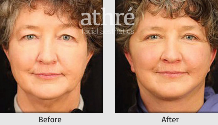 Close up of patient's face before and after facelift procedure.