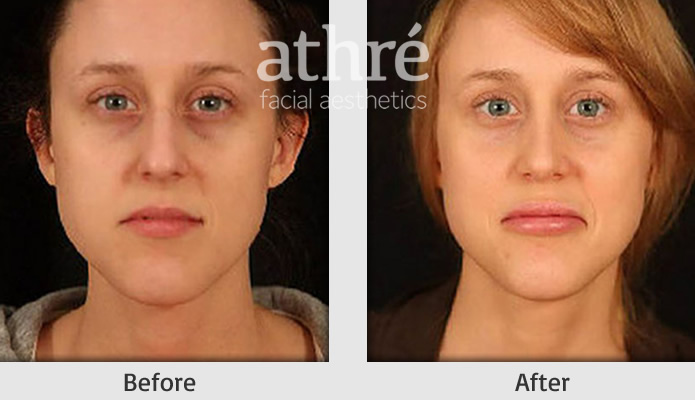 Close up of patient's face before and after lip augmentation treatment.