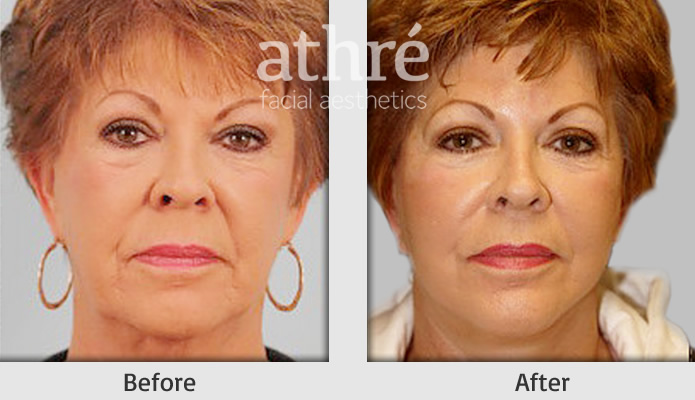 Close up of patient's face before and after lip augmentation treatment.