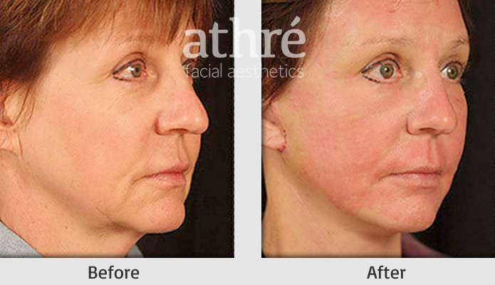 Close up of patient's face before and after mini facelift procedure.