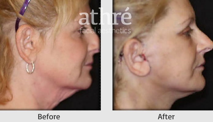 Close up of patient's face before and after mini facelift procedure.