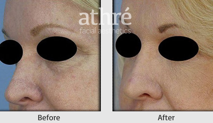 Close up of patient's face before and after OcuRX procedure.