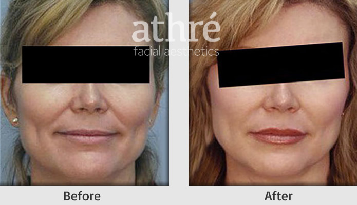 Close up of patient's face before and after Restylane® treatment.