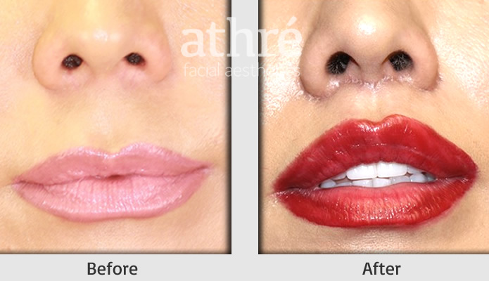 Close up of patient's face before and after lip lift procedure.
