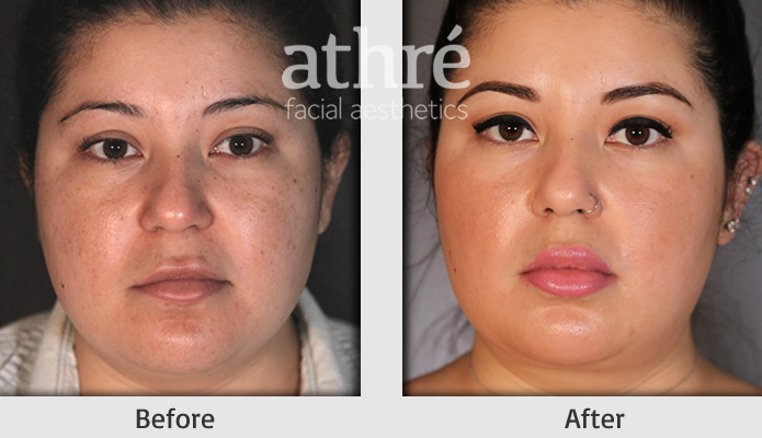 Close up of patient's face before and after Restylane® treatment.