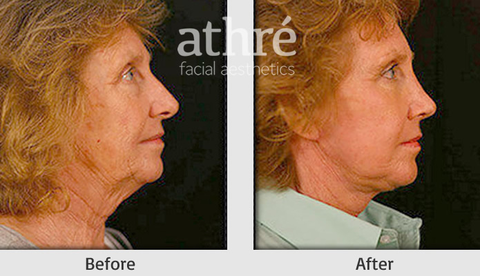 Close up of patient's face before and after rhinoplasty procedure.