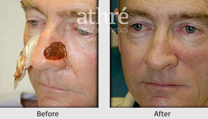 Close up of patient's face before and after skin care reconstruction procedure.