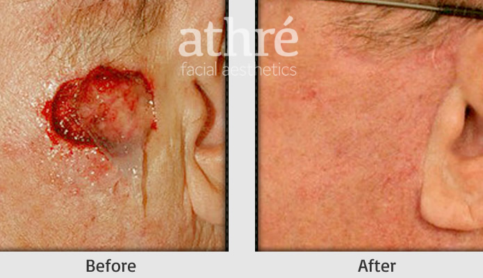 Close up of patient's face before and after skin cancer reconstruction procedure.