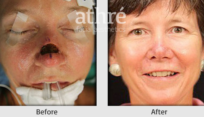 Close up of patient's face before and after skin cancer reconstruction procedure.