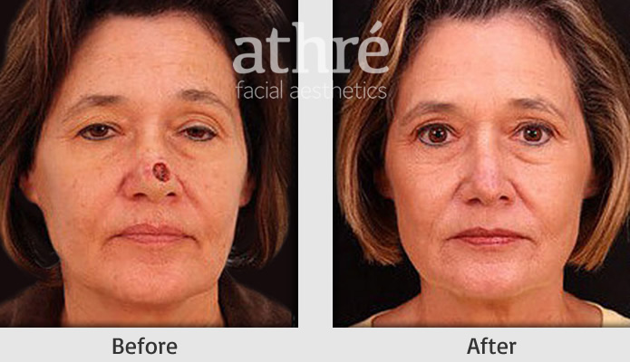 Close up of patient's face before and after skin care reconstruction procedure
