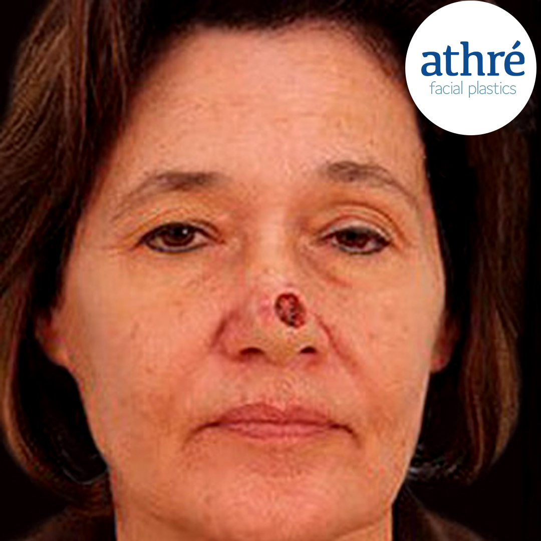 Rhinoplasty Patient Photo - Case 5047 - before view-