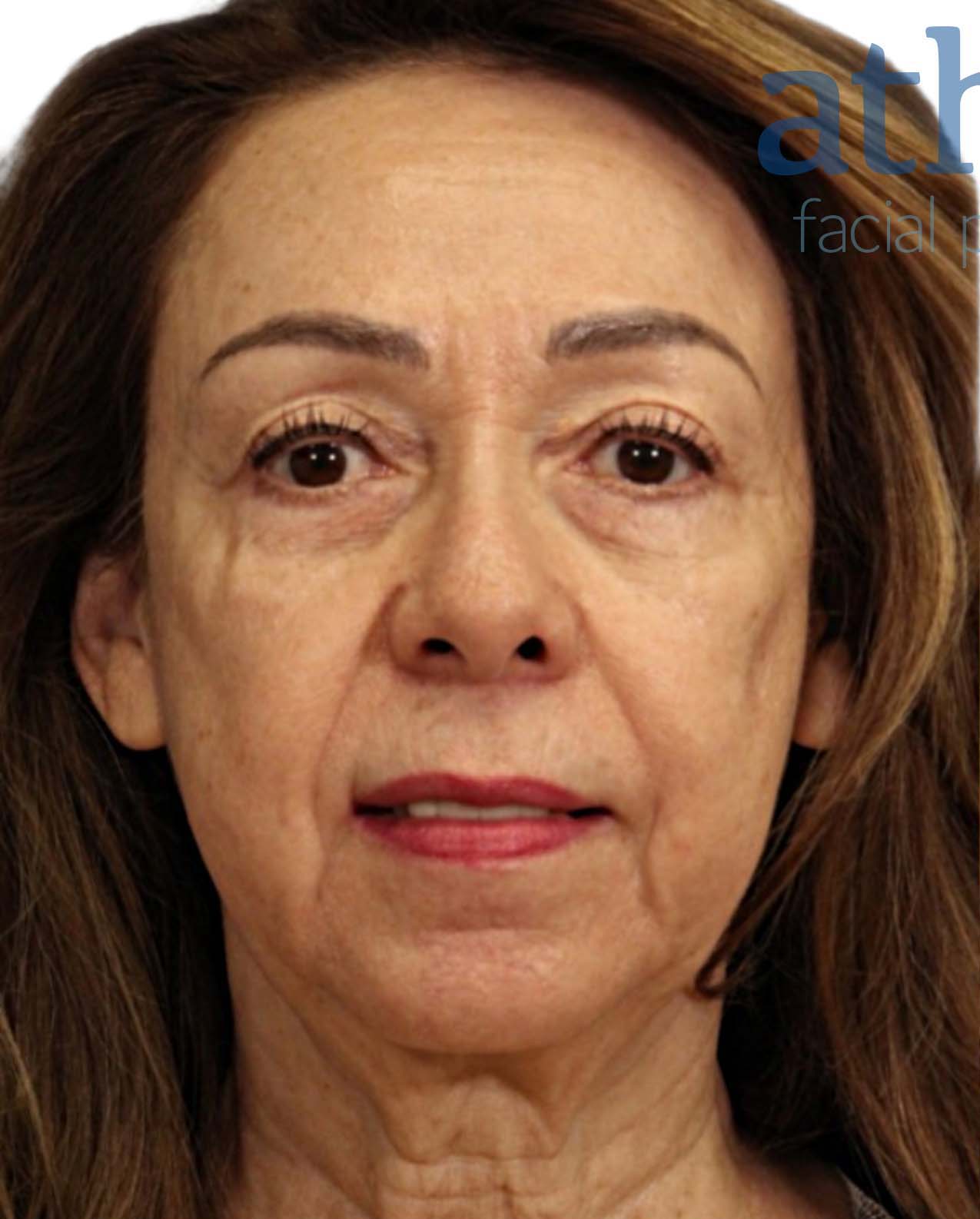 Eyelid Surgery Patient Photo - Case 5190 - before view-1