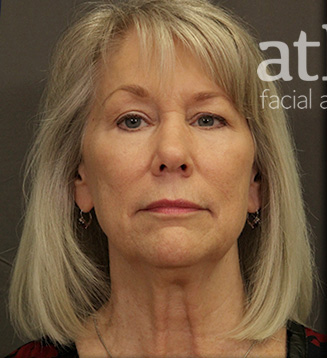 Brow Lift Patient Photo - Case 5240 - before view-
