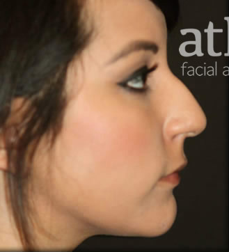 Rhinoplasty Patient Photo - Case 5255 - before view-0