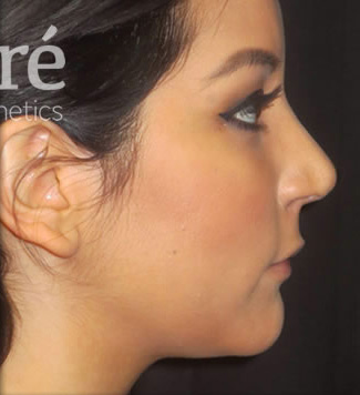 Rhinoplasty Patient Photo - Case 5255 - after view-0