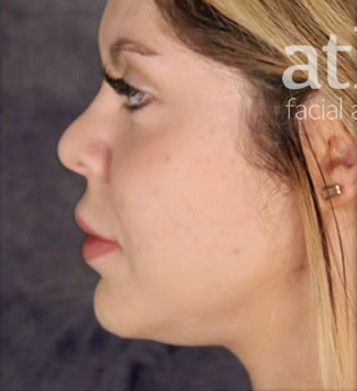 Revision Rhinoplasty Patient Photo - Case 5256 - before view-1