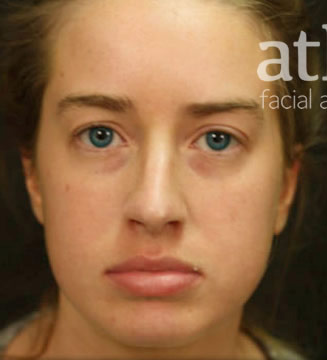 Revision Rhinoplasty Patient Photo - Case 5266 - before view-1