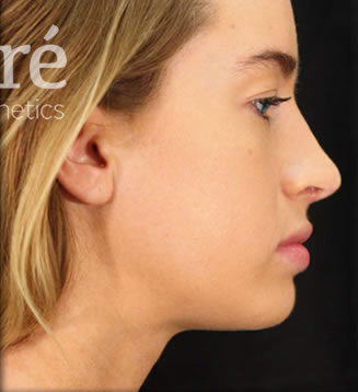 Revision Rhinoplasty Patient Photo - Case 5266 - after view