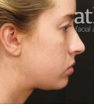 Revision Rhinoplasty Patient Photo - Case 5266 - before view-0