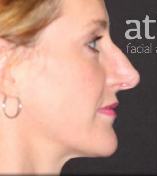 Rhinoplasty Patient Photo - Case 5460 - before view-1